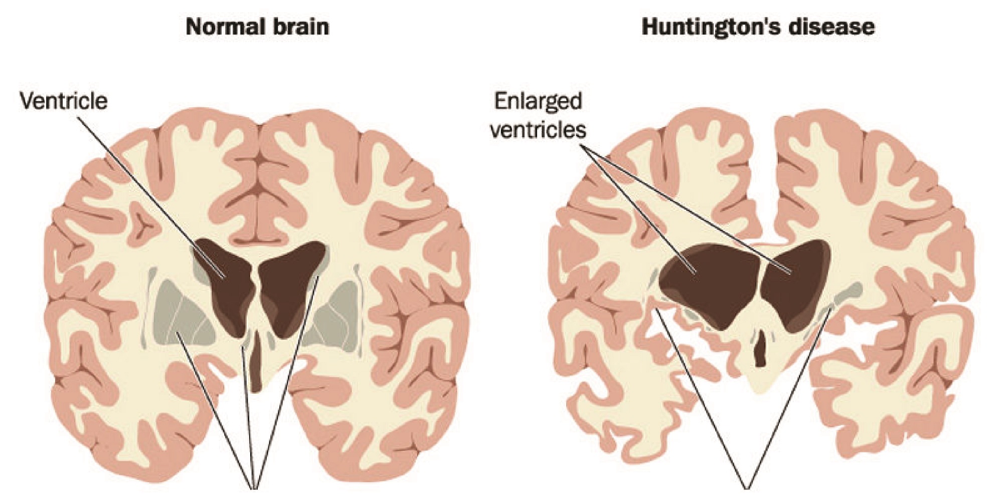 What are the Signs and Symptoms of Huntington’s Disease Bridge Clinic